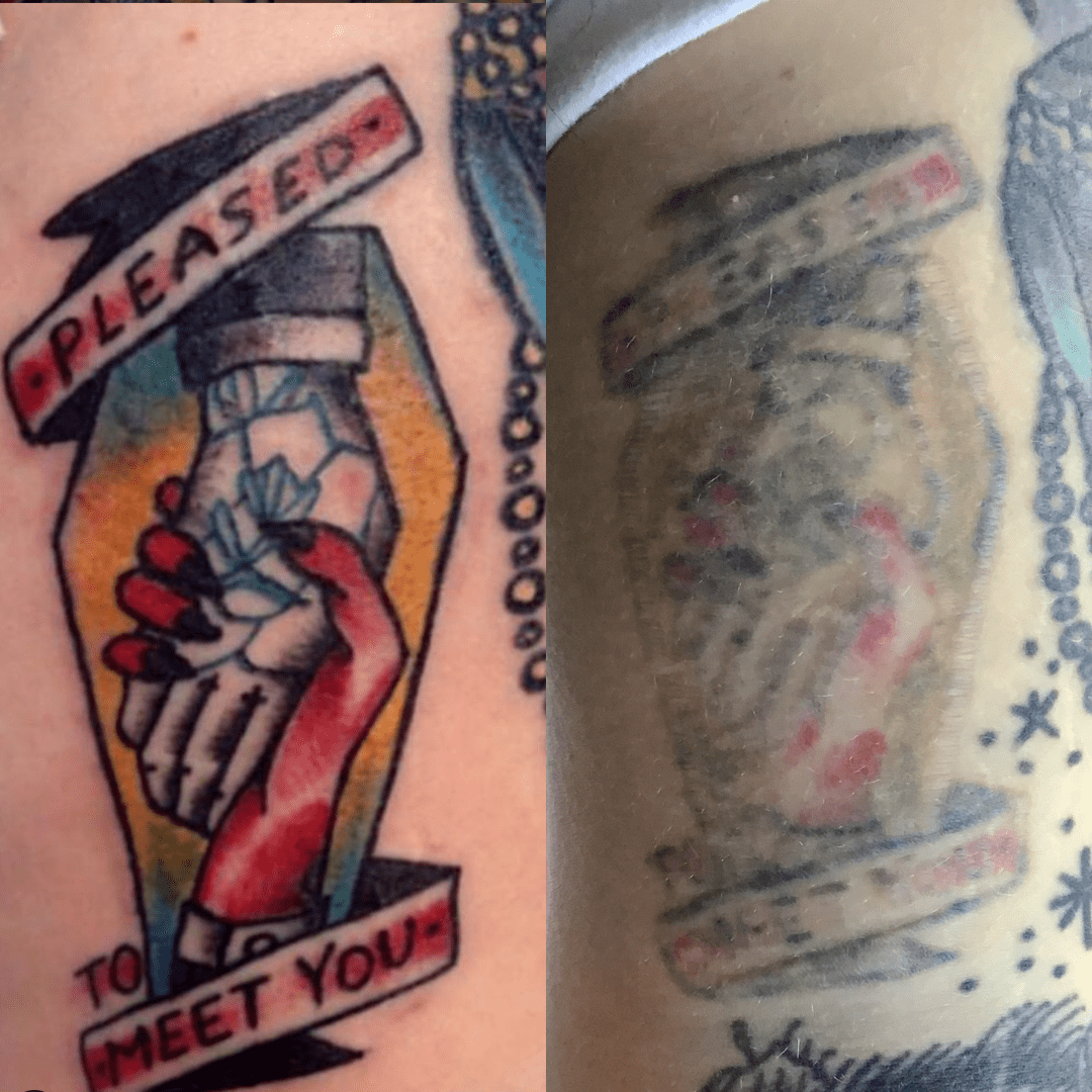 tattoo removal, tattoo fading, arm tattoo, coffin tattoo, 
