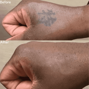 hand tattoo removal before and after
