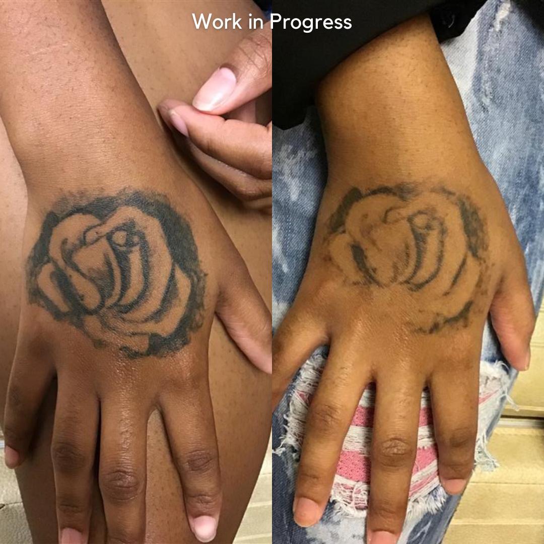 Vol 2: Top 6 Tattoo Removals on Dark Skin Types | Removery