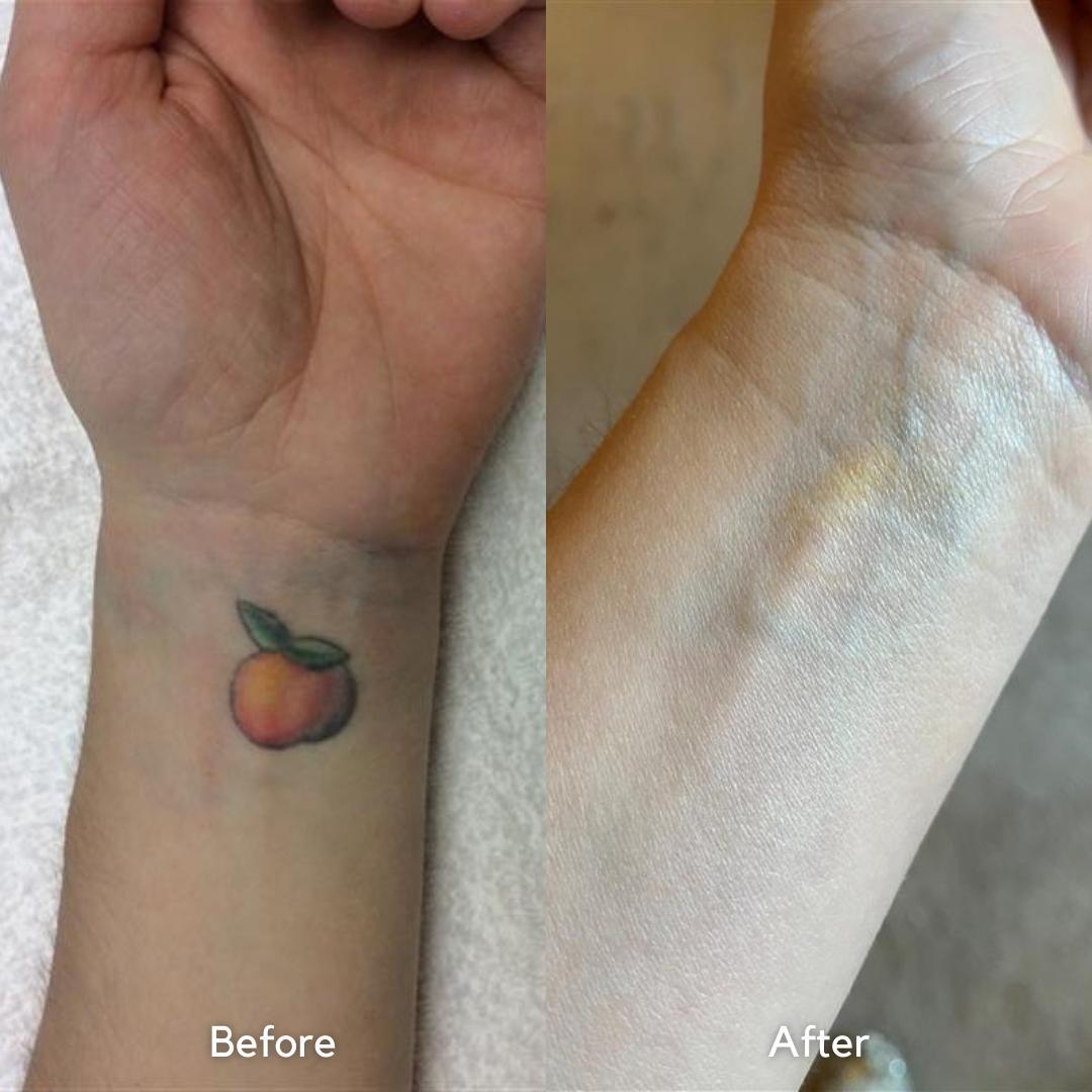 Newer tattoo. Do you guys think this is removable? The left is what I have  now and the right is what is covered up. It's not the worst tattoo but it's  just