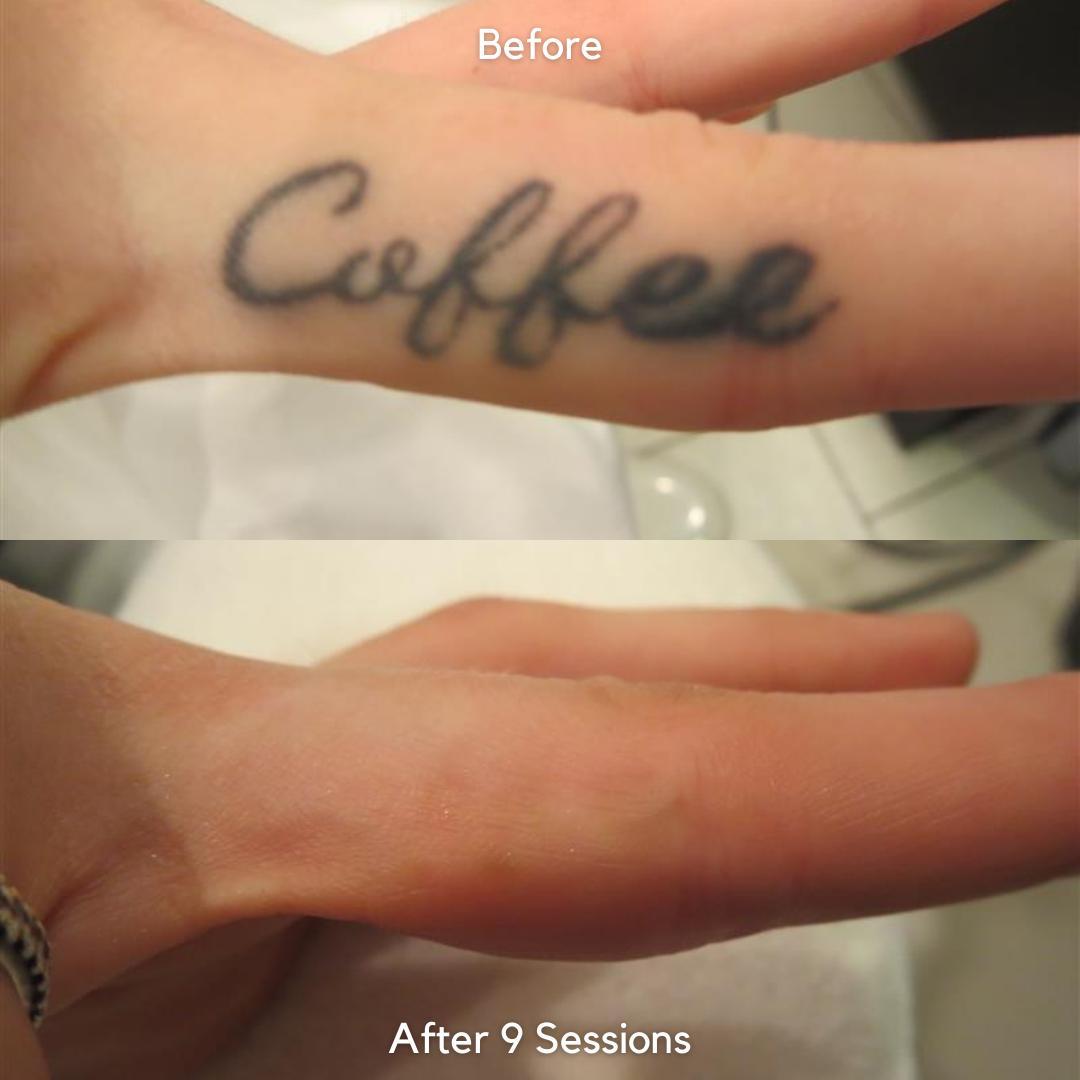 Tattooentfernung vorher und nachher