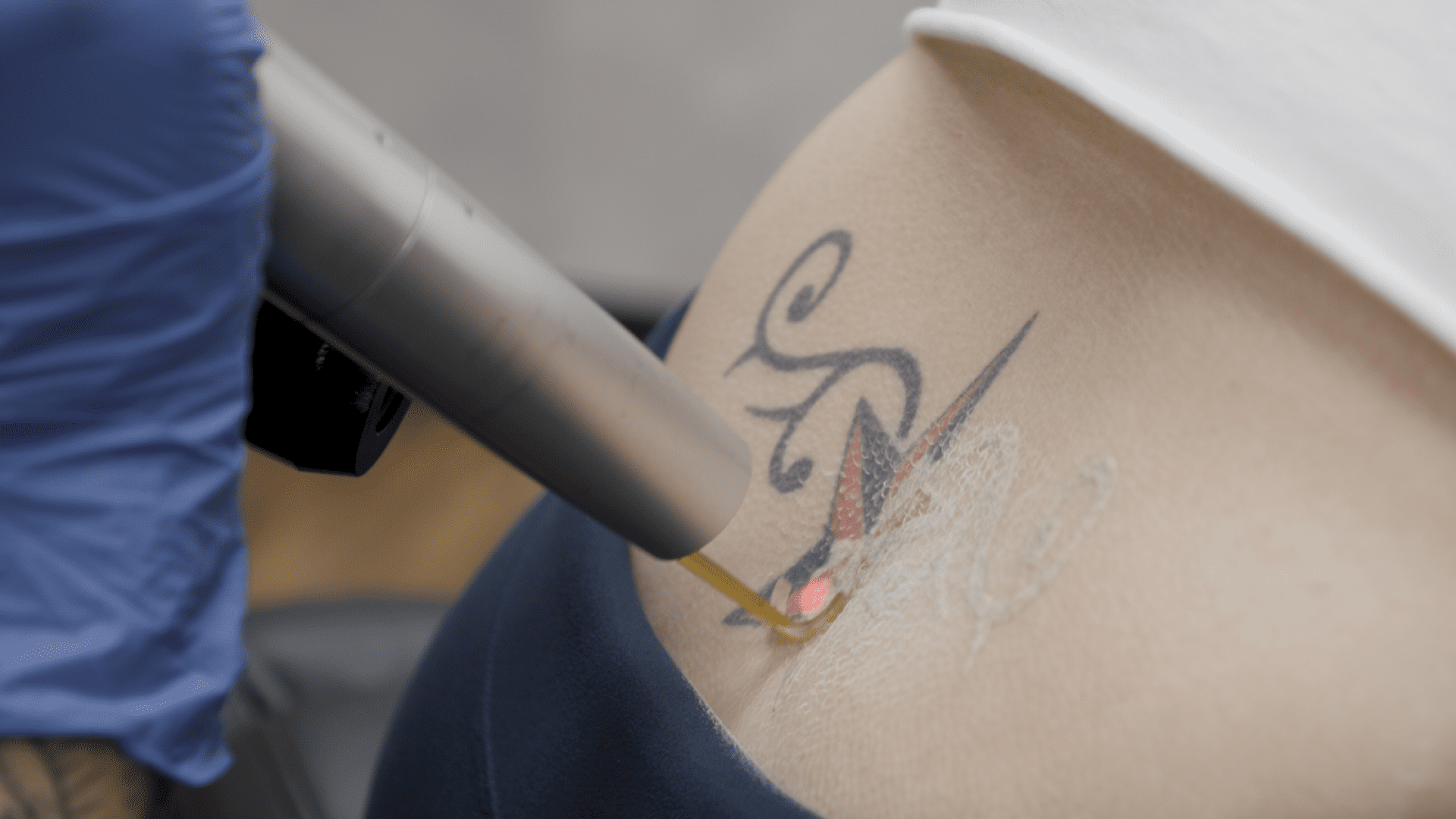 How does laser tattoo removal work What is the mechanism  Quora