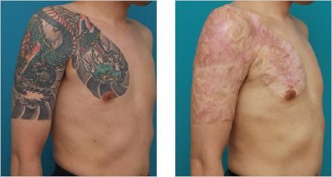 Tattoo Removal Creams: Do They Actually Work? | Removery
