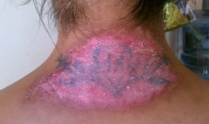 5 Tattoo Removal Methods That Simply Don't Work | Removery