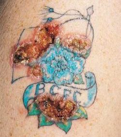 Tattoo-Infektion, Stadien der Tattoo-Infektion, infiziertes Tattoo, Tattoo-Blasenbildung, Tattoo-Ausschlag, Tattoo-Narbenbildung, Tattoo-Schwellung, Tattoo-Entzündung, Allergien gegen rotes Tattoo, Tattoo-Allergie, juckendes Tattoo, erhabenes Tattoo