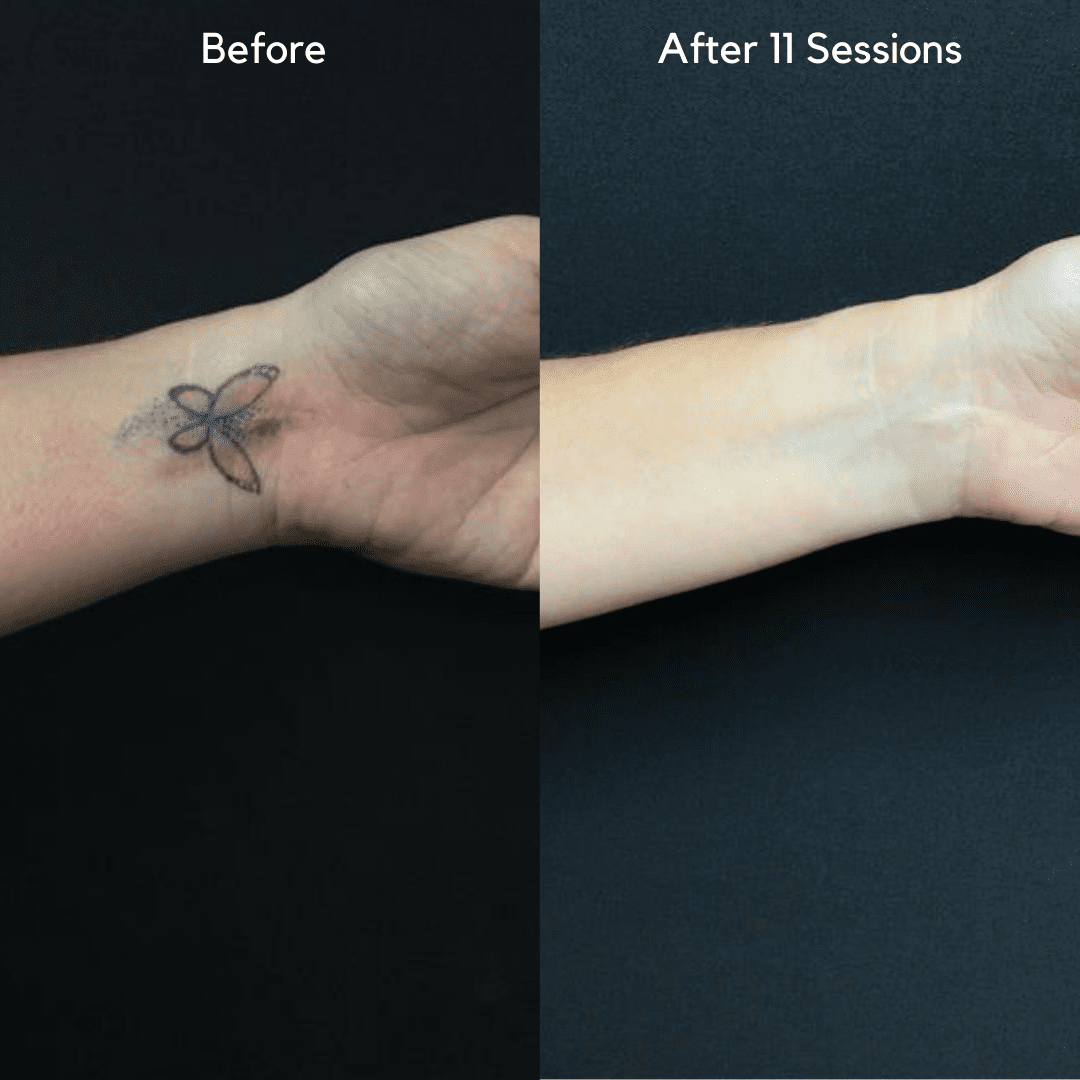 wrist tattoo removal before and after