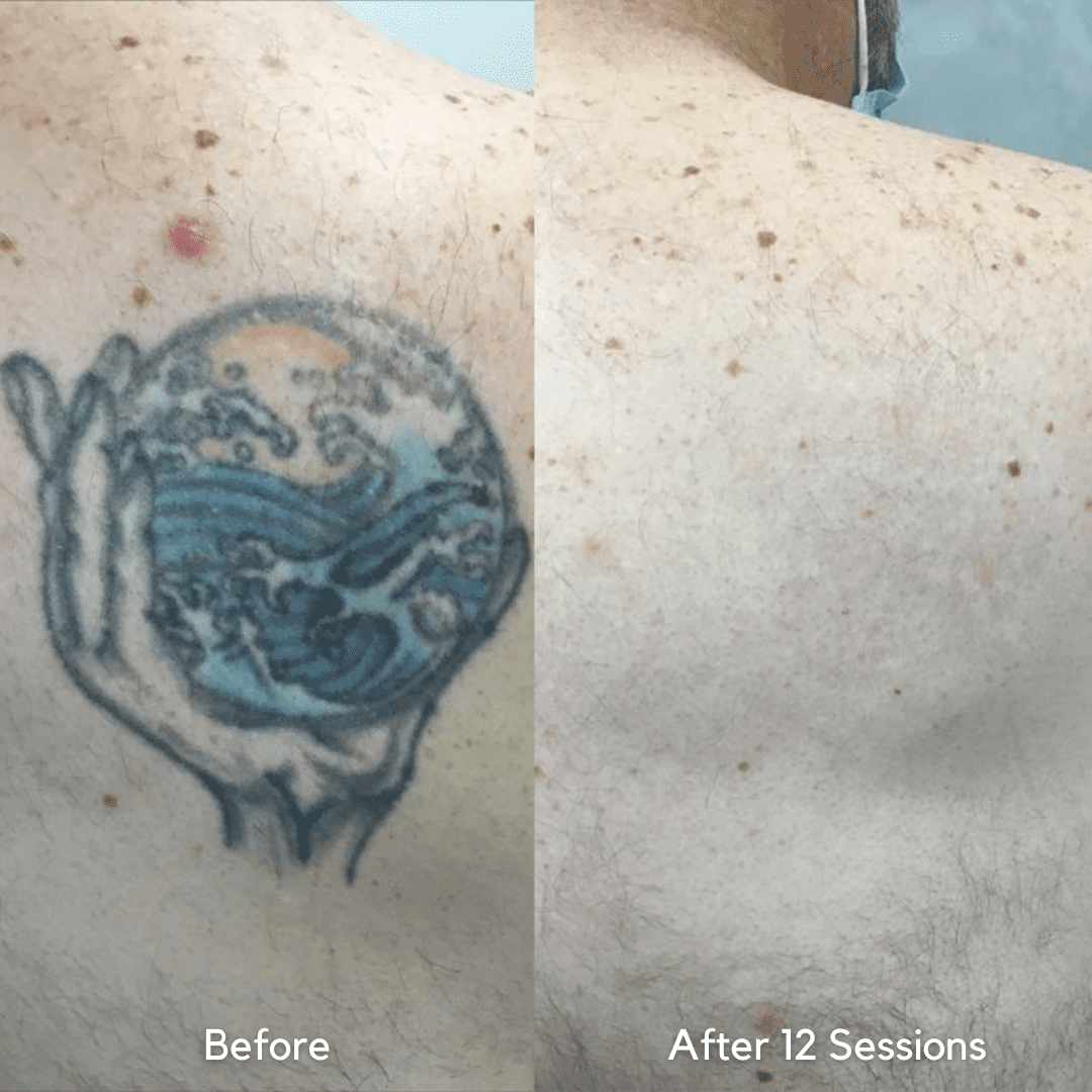 Vol 2: Best Of 2021 Before & After Tattoo Removal Results | Removery