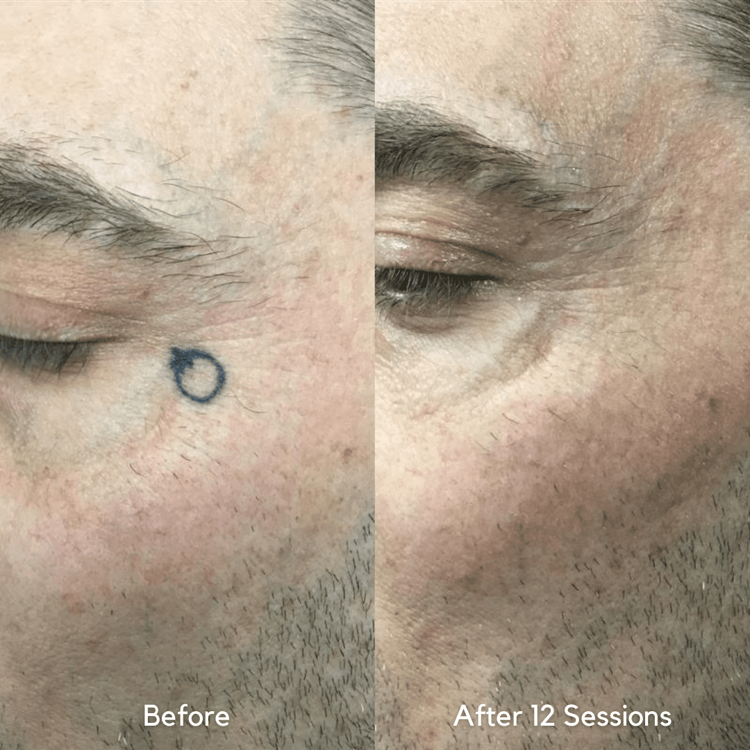 face tattoo removal before and after