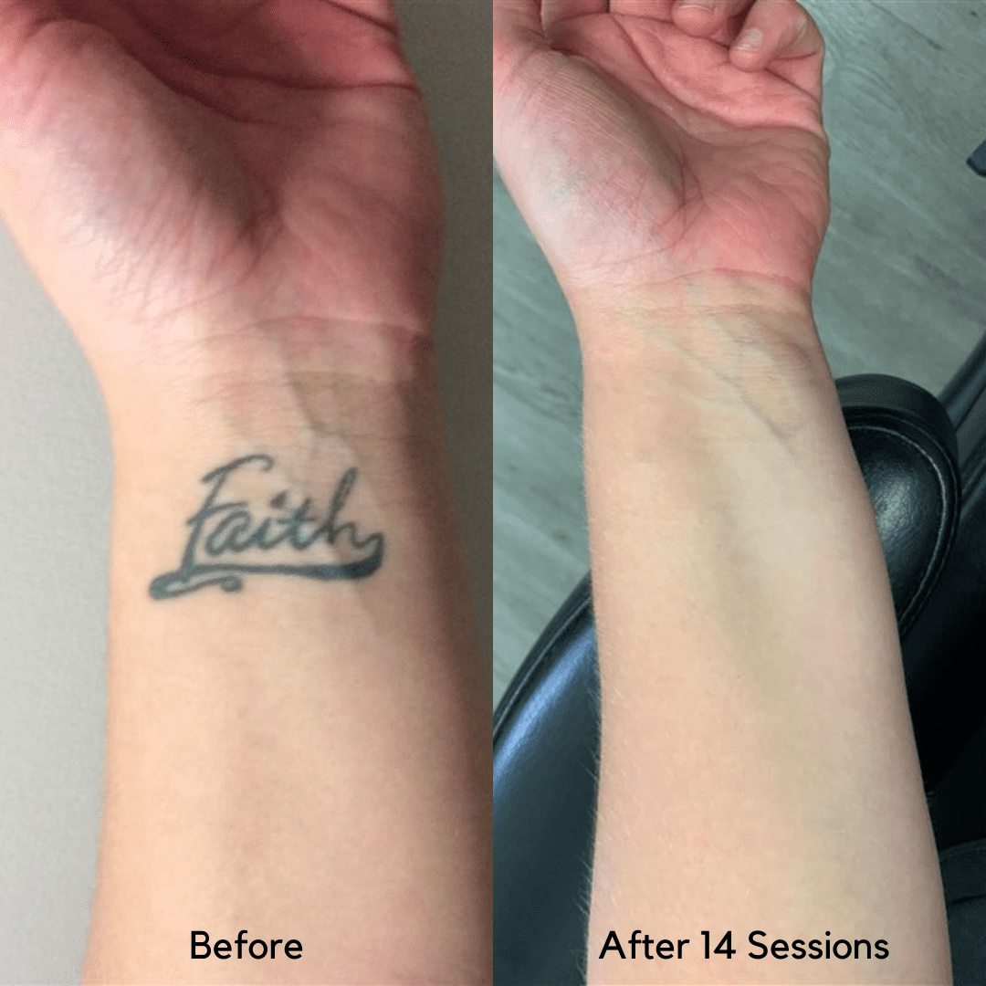 wrist tattoo removal before and after