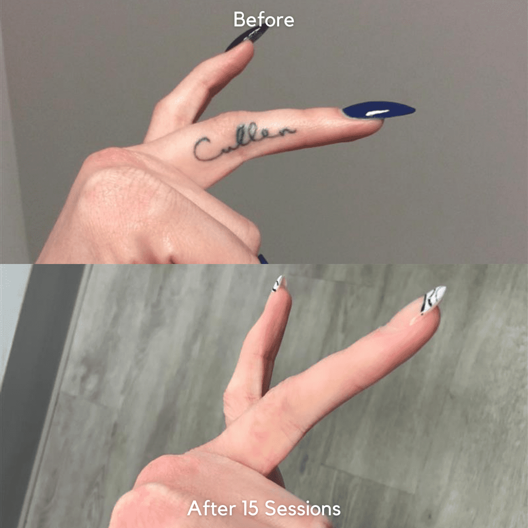 before and after finger tattoo removal