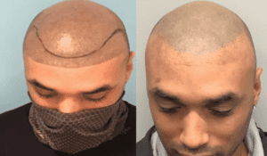 microblading tattoo removal before and after