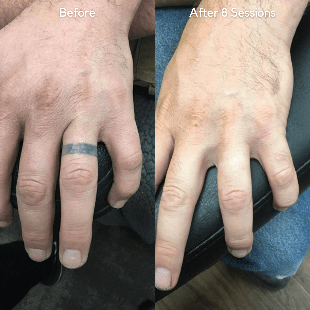 before and after finger tattoo removal
