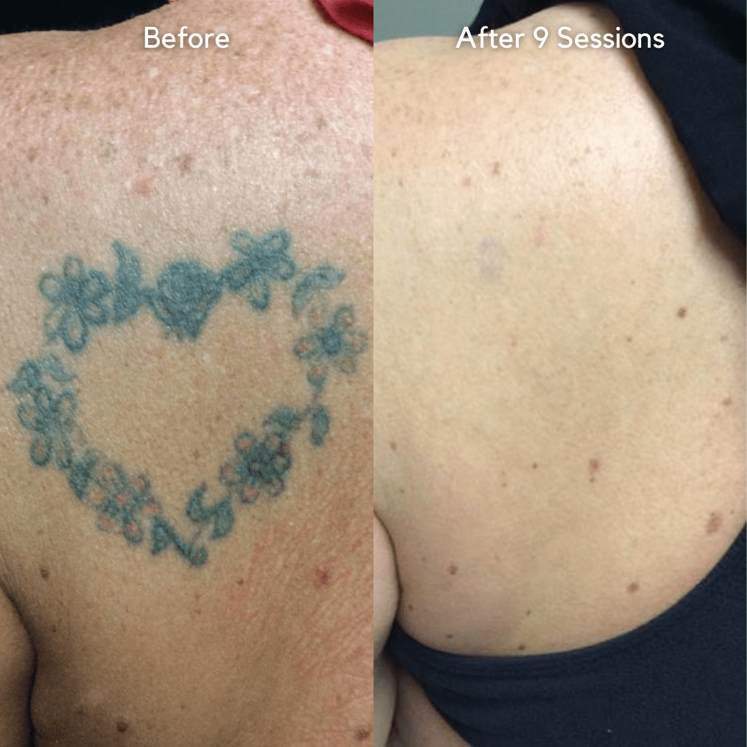back tattoo before and after results