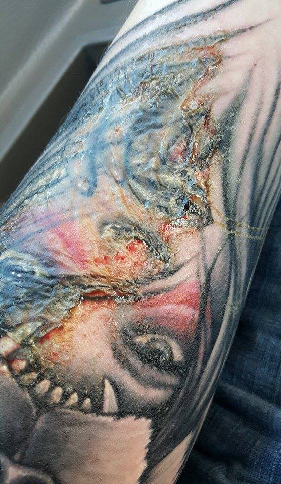 Infected Tattoo Stages: Signs of Infection from Tattoos and After Tattoo  Removal | Removery