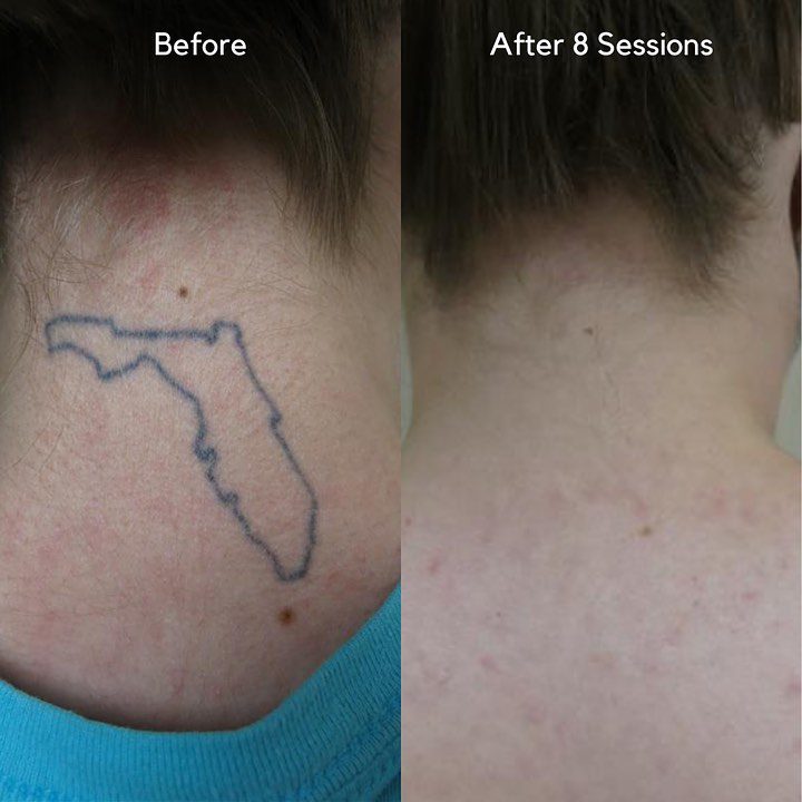 neck tattoo before and after