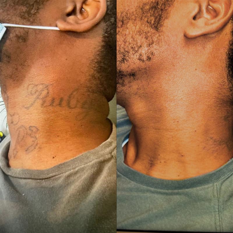 Tattoo Removal Progress: What Results to Expect | Removery