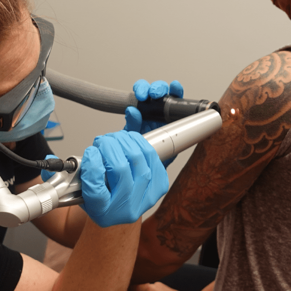 close up of a laser technician wearing safety googles and gloves while using a laser on an arm tattoo