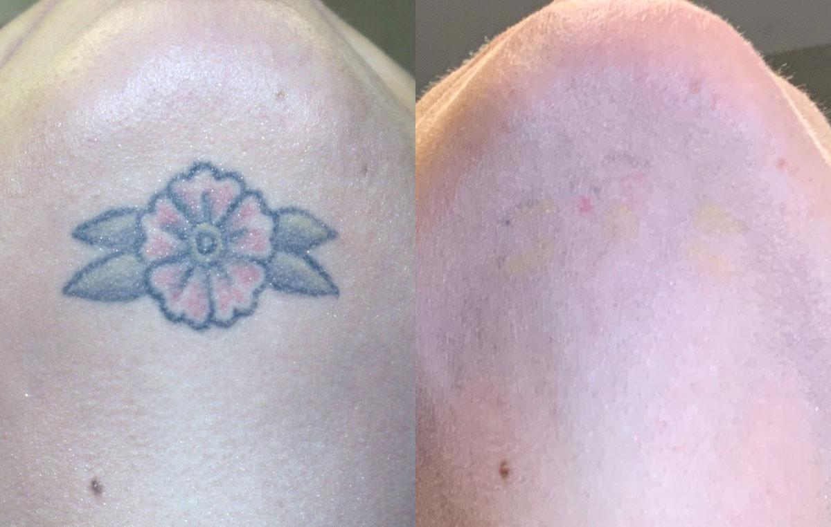 tattoo removed with laser