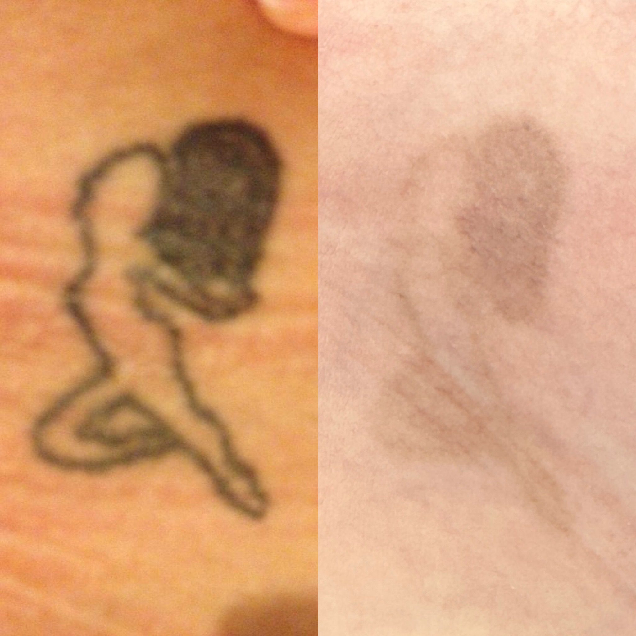 lauren-pay-national-tattoo-removal-day-3