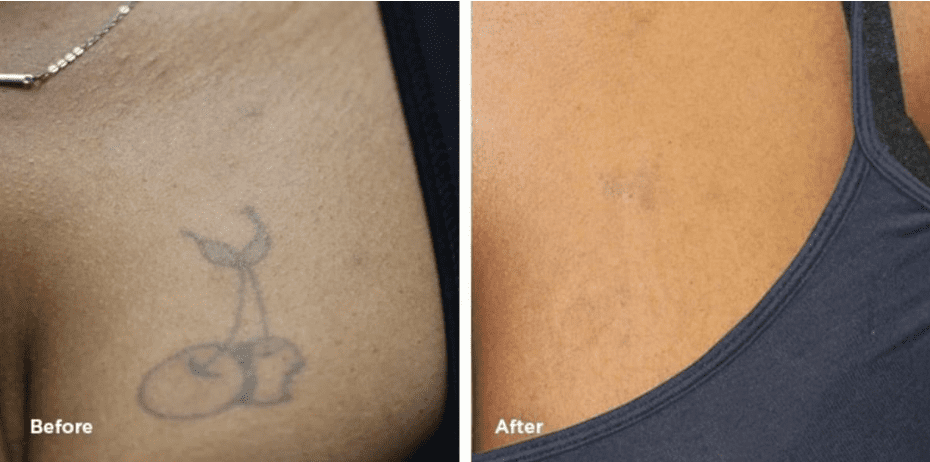 Chest tattoo removal removery tattoo removal and fading