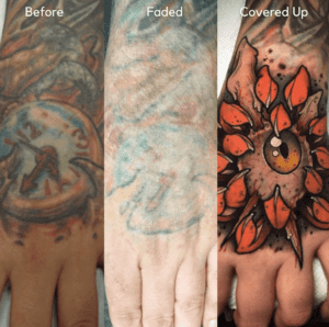Hand tattoo removal before and after