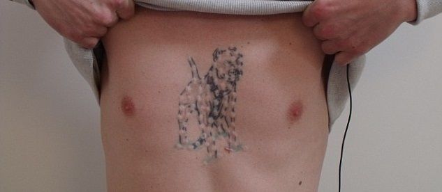 injection tattoo removal results