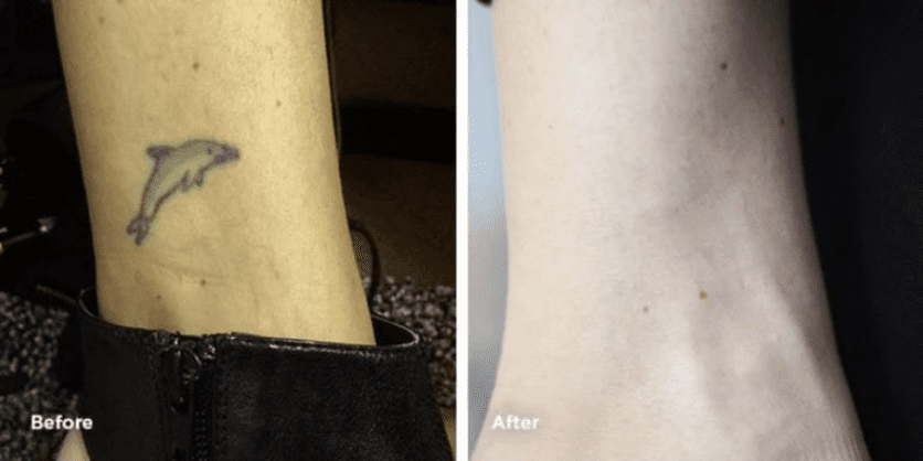 Leg cover up tattoo removal at Removery Tattoo Removal and Fading: The World's Leading Tattoo Removal Experts