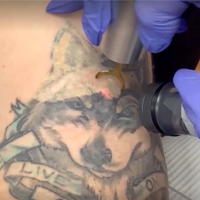 tattoo removal wolf laser tattoo removal