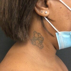 before removal