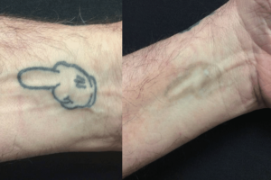 Hyperpigmentation before and after from tattoo removal. On the left side you can see the tattoo before, and on the right side has hyperpigmentation. This can be treated but requires additional steps.