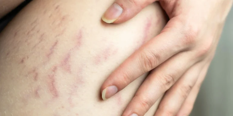 Tattoo Removal Stretch Mark Cover up