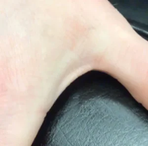 after removal