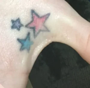 before removal