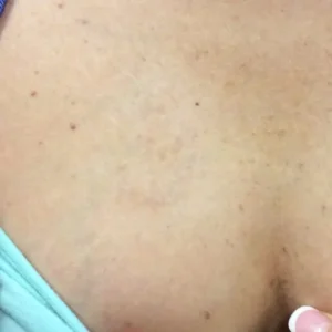 after removal
