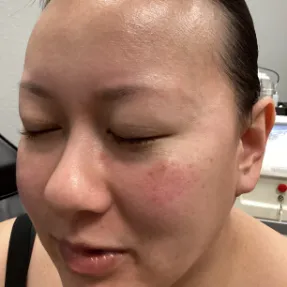 después de la eliminación