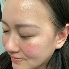 antes de la eliminación