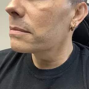 antes de la eliminación